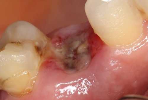 Воспаление после удаления зуба:  симптомы,
