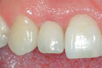 Не избежать имплантации зубов и в том случае, когда у пациента наблюдается такая паталогия, как полная адентия зуба