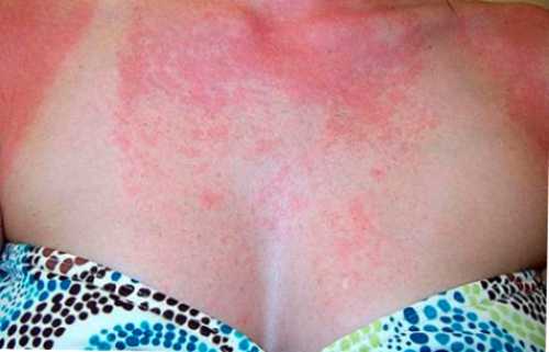 Аллергия, которая появляется после взаимодействия ультрафиолетовых лучей с различными веществами